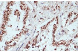 Immunohistochemistry of paraffin-embedded Human lung cancer using Phospho-β-catenin(S33/S37/T41) Polyclonal Antibody at dilution of 1:100 (40x lens).