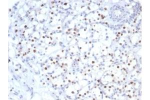 IHC analysis of formalin-fixed, paraffin-embedded human kidney cancer. (Recombinant CDKN1C 抗体)