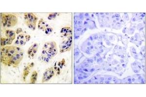Immunohistochemistry analysis of paraffin-embedded human breast carcinoma, using CBL (Phospho-Tyr700) Antibody. (CBL 抗体  (pTyr700))