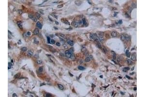 Detection of C2CD3 in Human Pancreatic cancer Tissue using Polyclonal Antibody to C2 Calcium Dependent Domain Containing Protein 3 (C2CD3) (C2CD3 抗体  (AA 1432-1647))