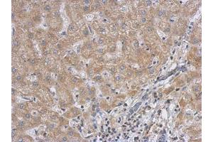 IHC-P Image Immunohistochemical analysis of paraffin-embedded human hepatoma, using RACGAP1, antibody at 1:500 dilution. (RACGAP1 抗体  (N-Term))
