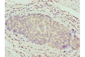 Immunohistochemistry of paraffin-embedded human gastric cancer using ABIN7176132 at dilution of 1:100 (ZNF177 抗体  (AA 1-321))