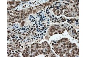 Immunohistochemical staining of paraffin-embedded Adenocarcinoma of colon tissue using anti-MCL1 mouse monoclonal antibody. (MCL-1 抗体)