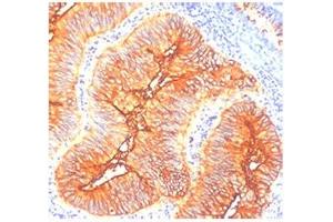 IHC staining of human colon cancer with TAG-72 antibody (TAG-72 抗体)