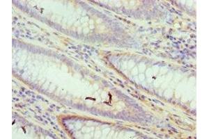 Immunohistochemistry of paraffin-embedded human colon cancer using ABIN7150176 at dilution of 1:100 (DFFA 抗体  (AA 1-331))
