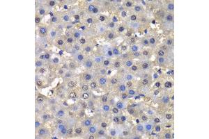 Immunohistochemistry of paraffin-embedded human liver injury using DHFR antibody at dilution of 1:100 (400x lens). (Dihydrofolate Reductase 抗体)