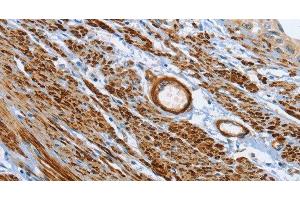 Immunohistochemistry of paraffin-embedded Human cervical cancer tissue using SHROOM2 Polyclonal Antibody at dilution 1:50 (SHROOM2 抗体)