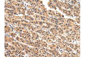 The image on the left is immunohistochemistry of paraffin-embedded Human liver cancer tissue using ABIN7128081(VIL1 Antibody) at dilution 1/30, on the right is treated with fusion protein. (Villin 1 抗体)