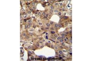 CCNI2 Antibody (Center) immunohistochemistry analysis in formalin fixed and paraffin embedded human breast carcinoma followed by peroxidase conjugation of the secondary antibody and DAB staining. (CCNI2 抗体  (Middle Region))