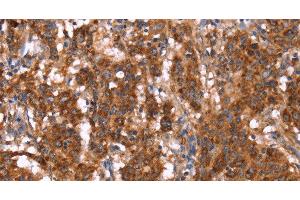 Immunohistochemistry of paraffin-embedded Human gastric cancer tissue using GAGE12I Polyclonal Antibody at dilution 1:30 (G Antigen 12I 抗体)