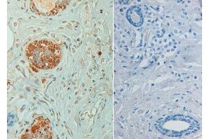 Immunohistochemistry of Rabbit anti STAT6 pY641 Antibody in human breast carcinoma pH 9(left) with negative control (right) Tissue: Human breast carcinoma (STAT6 抗体  (Internal Region, pTyr641))