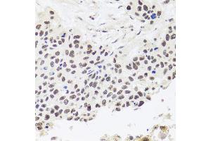 Immunohistochemistry of paraffin-embedded human lung cancer using RPP30 antibody. (RPP30 抗体)
