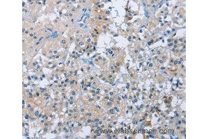 Immunohistochemistry of Human thyroid cancer using BTN2A2 Polyclonal Antibody at dilution of 1:50 (BTN2A2 抗体)