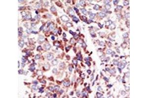 IHC analysis of FFPE human hepatocarcinoma tissue stained with the TIE2 antibody (TEK 抗体  (AA 758-789))