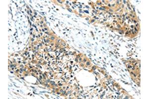 The image on the left is immunohistochemistry of paraffin-embedded Human esophagus cancer tissue using ABIN7190846(GPR15 Antibody) at dilution 1/20, on the right is treated with synthetic peptide. (GPR15 抗体)