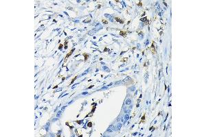 Immunohistochemistry of paraffin-embedded human colon carcinoma using NF Rabbit pAb (ABIN6130595, ABIN6144558, ABIN6144559 and ABIN6222368) at dilution of 1:200 (40x lens). (NFATC3 抗体  (AA 1-290))
