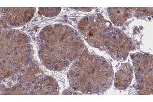 ABIN6274043 at 1/100 staining Human liver cancer tissue by IHC-P. (RhoA,B,C 抗体)