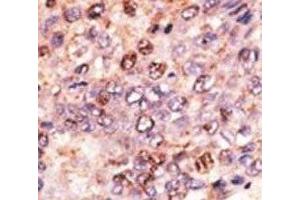 IHC analysis of FFPE human hepatocarcinoma tissue stained with the ABCB7 antibody (ABCB7 抗体  (AA 718-746))