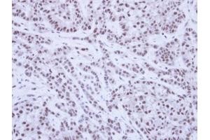 IHC-P Image Immunohistochemical analysis of paraffin-embedded A549 Xenograft, using SAE1, antibody at 1:100 dilution. (SAE1 抗体)