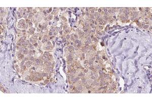 ABIN6273351 at 1/100 staining Human thyroid cancer tissue by IHC-P. (ZFYVE16 抗体  (C-Term))