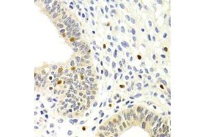 Immunohistochemistry of paraffin-embedded human uterine cancer using GEMIN2 Antibody. (SIP1 抗体)