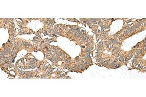 Immunohistochemistry of paraffin-embedded Human colorectal cancer tissue using AHNAK Polyclonal Antibody at dilution of 1:50(x200) (AHNAK 抗体)