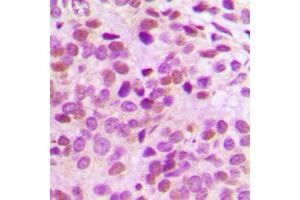 Immunohistochemical analysis of GATA3 staining in human breast cancer formalin fixed paraffin embedded tissue section. (GATA3 抗体  (Center))