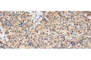 Immunohistochemistry of paraffin-embedded Human breast cancer using TBL1X Polyclonal Antibody at dilution of 1/30 (TBL1X 抗体)