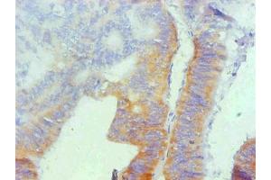 Immunohistochemical of paraffin-embedded human colon cancer using ABIN7162321 at dilution of 1:200 (Osteopontin 抗体)