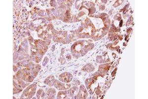 IHC-P Image Guanylate kinase antibody detects GUK1 protein at cytosol on CX-1 xenograft by immunohistochemical analysis. (GUK1 抗体)