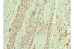 Immunohistochemistry of paraffin-embedded human colon cancer using ABIN7156926 at dilution of 1:100 (IL7R 抗体  (AA 21-239))