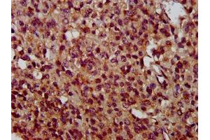 IHC image of ABIN7173123 diluted at 1:400 and staining in paraffin-embedded human glioma performed on a Leica BondTM system. (TMEM192 抗体  (AA 193-271))