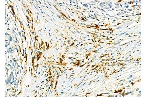 ABIN6259473 and ABIN6275568 at 1/100 staining Human pancreatic cancer and adjacent nomal tissues by IHC-P. (SH3RF3 抗体  (C-Term))