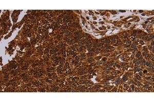 Immunohistochemistry of paraffin-embedded Human lung cancer tissue using NDUFAB1 Polyclonal Antibody at dilution 1:50 (NDUFAB1 抗体)