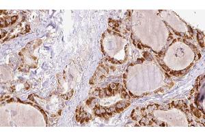 ABIN6267199 at 1/100 staining Human thyroid cancer tissue by IHC-P. (TNK1 抗体  (pTyr277))