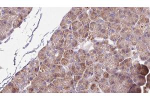 ABIN6273264 at 1/100 staining Human pancreas cancer tissue by IHC-P. (SLC39A6 抗体  (Internal Region))
