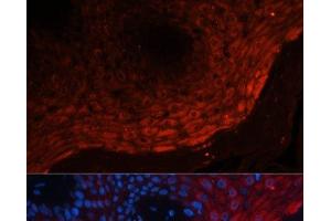 Immunofluorescence analysis of Human skin cancer using S100A8 Polyclonal Antibody at dilution of 1:100 (40x lens). (S100A8 抗体)