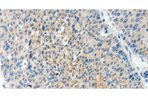 Immunohistochemistry of paraffin-embedded Human liver cancer using TPM2 Polyclonal Antibody at dilution of 1:60 (TPM2 抗体)