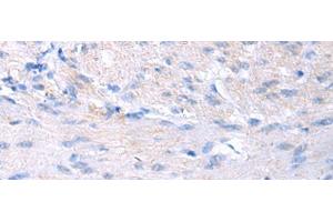 Immunohistochemistry of paraffin-embedded Human gastric cancer tissue using PROC Polyclonal Antibody at dilution of 1:80(x200) (PROC 抗体)