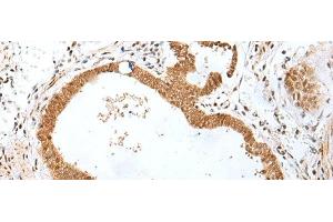 Immunohistochemistry of paraffin-embedded Human gastric cancer tissue using PEG3 Polyclonal Antibody at dilution of 1:45(x200) (PEG3 抗体)