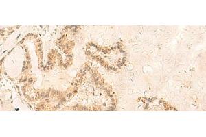 Immunohistochemistry of paraffin-embedded Human thyroid cancer tissue using ZNF85 Polyclonal Antibody at dilution of 1:35(x200) (ZNF85 抗体)