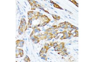 Immunohistochemistry of paraffin-embedded human esophageal cancer using STIP1 Rabbit mAb (ABIN1512566, ABIN3020619, ABIN3020620 and ABIN7101303) at dilution of 1:100 (40x lens). (STIP1 抗体)