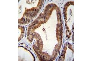 Formalin fixed, paraffin embedded human prostate carcinoma stained with SHQ1 Antibody (N-term) followed by peroxidase conjugation of the secondary antibody and DAB staining. (SHQ1 抗体  (N-Term))