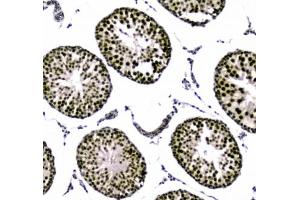 IHC testing of FFPE human breast cancer tissue with UBA2 antibody at 1ug/ml. (UBA2 抗体)