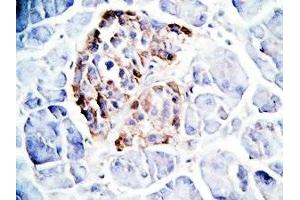 Human pancreas cancer tissue was stained by Rabbit Anti-GLP-1(7-36) -NH2 Antibody (GLP-1 抗体  (amidated))