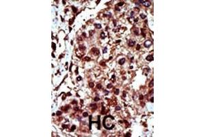 Formalin-fixed and paraffin-embedded human cancer tissue reacted with the primary antibody, which was peroxidase-conjugated to the secondary antibody, followed by AEC staining. (DGKI 抗体  (C-Term))
