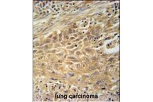 CNNM4 Antibody (Center) (ABIN651611 and ABIN2840324) immunohistochemistry analysis in formalin fixed and paraffin embedded human lung carcinoma followed by peroxidase conjugation of the secondary antibody and DAB staining. (CNNM4 抗体  (AA 565-593))
