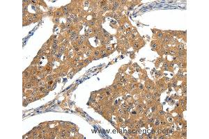 Immunohistochemistry of Human ovarian cancer using SCN5A Polyclonal Antibody at dilution of 1:30 (SCN5A 抗体)