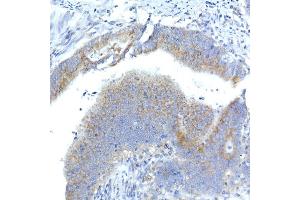 Immunohistochemistry of paraffin-embedded human colon carcinoma using Syntaxin 16 Rabbit mAb (ABIN7270681) at dilution of 1:50 (40x lens). (Syntaxin 16 抗体)