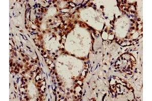 Immunocytochemistry analysis of human breast cancer using ABIN7147255 at dilution of 1:100